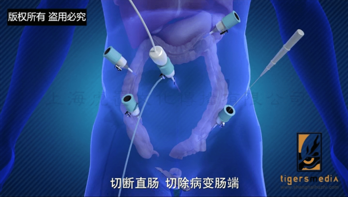 直肠癌手术治疗动画演示3D医疗医学动画制作